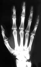 Hand X-ray Image