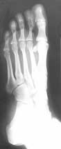 Foot X-ray Image